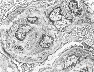 type I membranoproliferative glomerulonephritis type I membranoproliferative glomerulonephritis